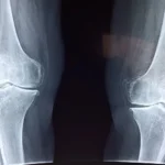 Joint Injuries