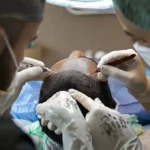 Hair Transplant Turkey