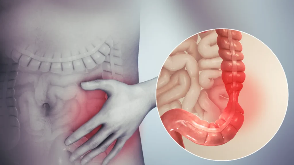 How FODMAPs Affect Digestive Health and IBD