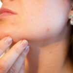 Pimple Patch